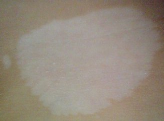 吸烟对白癜风的危害