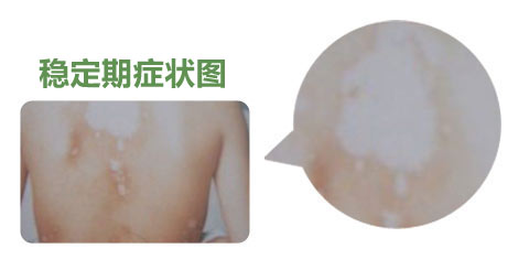 白癜风稳定期的症状表现